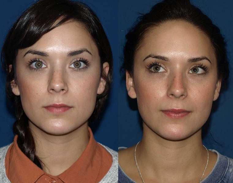 Rhinoplasty NYC Best of all elective surgical options in your local area
